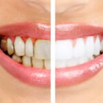 Everything You Need to Know About Tooth Enamel Erosion Part II